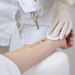 Trattamento laser per rimozione di tattoo