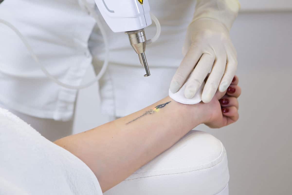 Trattamento laser per rimozione di tattoo