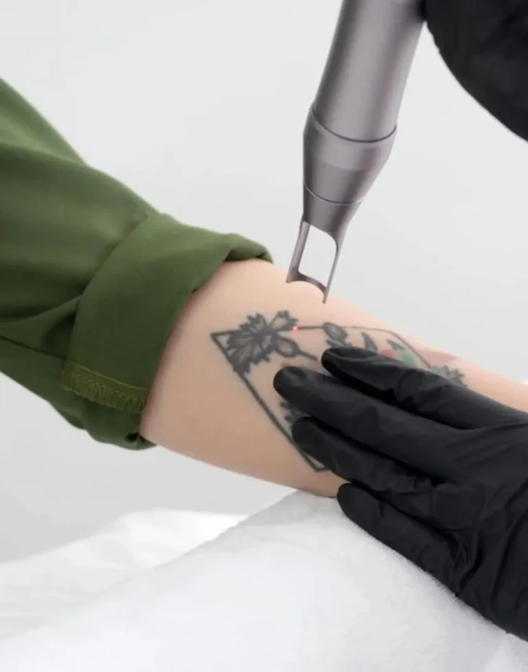 Braccio sottoposto a trattamento rimozione tatuaggio con laser