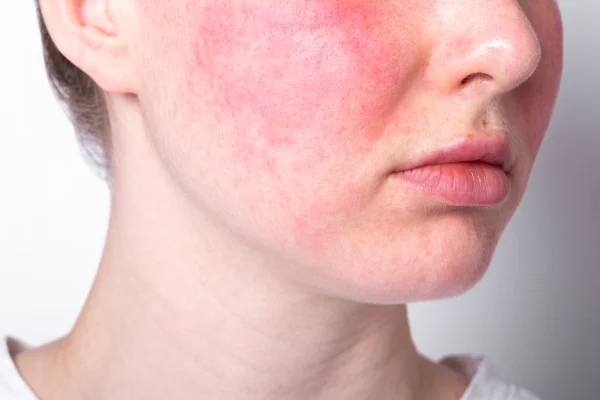 Primo piano di un viso con arrossamento localizzato sulle guance tipico della rosacea e della couperose.