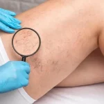 Gamba di una donna con evidenti capillari rotti visibili