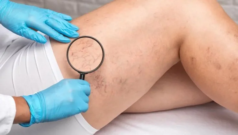 Gamba di una donna con evidenti capillari rotti visibili