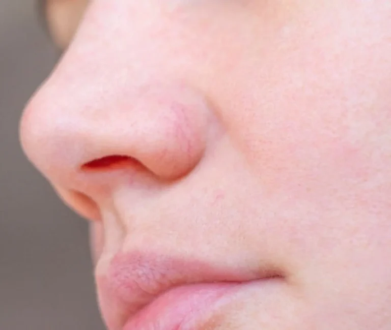 Naso con capillari rotti