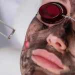 Esecuzione del trattamento carbon peel laser