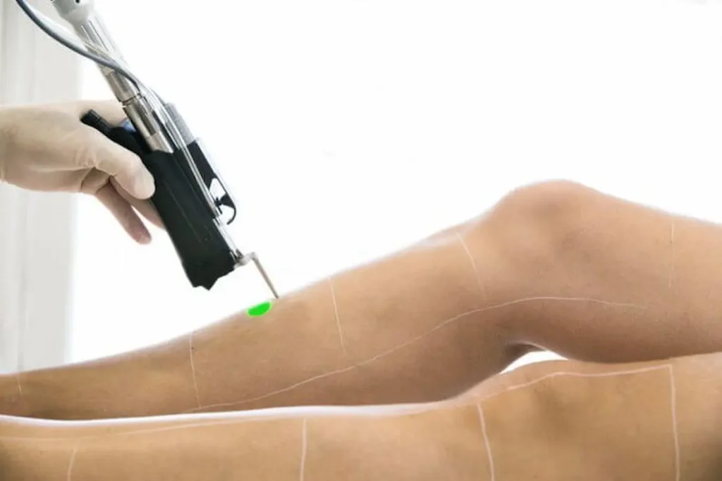 Trattamento di epilazione laser medicale