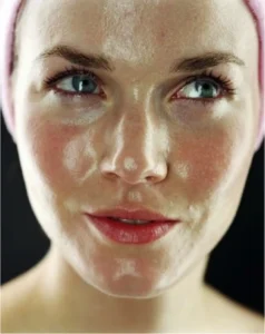 viso di una donna con pelle grassa