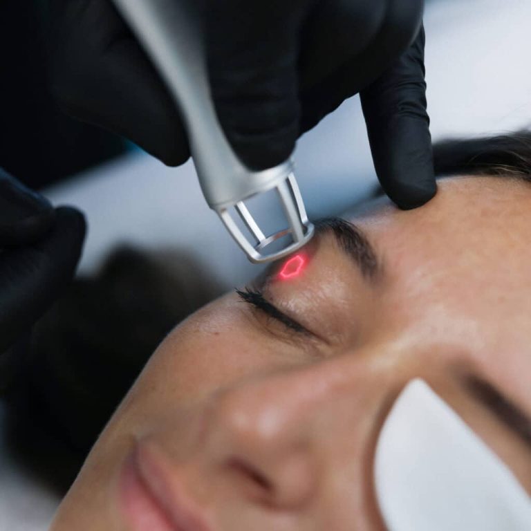 Blefarolaser in Aurial - Palpebre cadenti trattamento laser