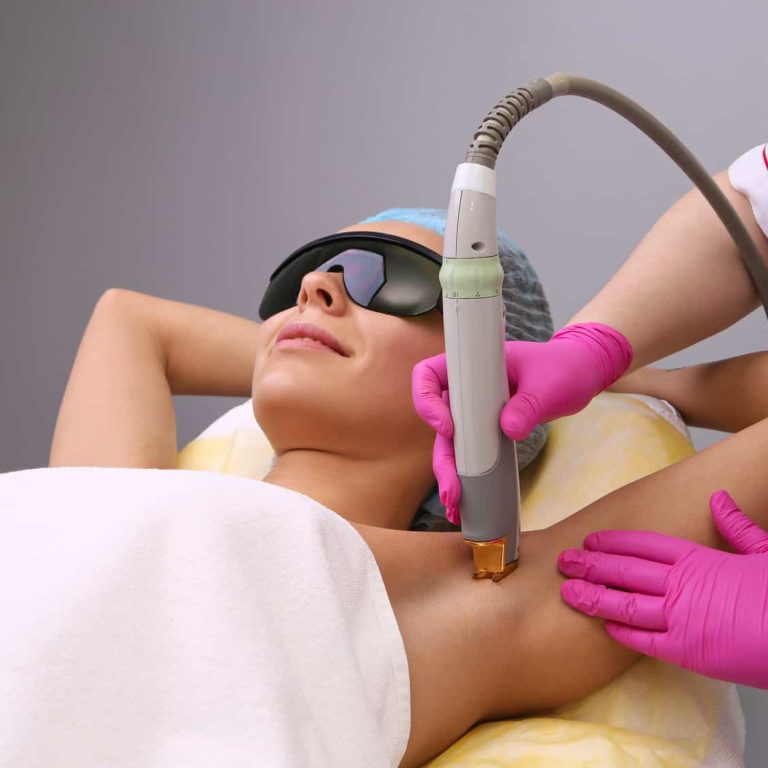 epilazione laser alessandrite