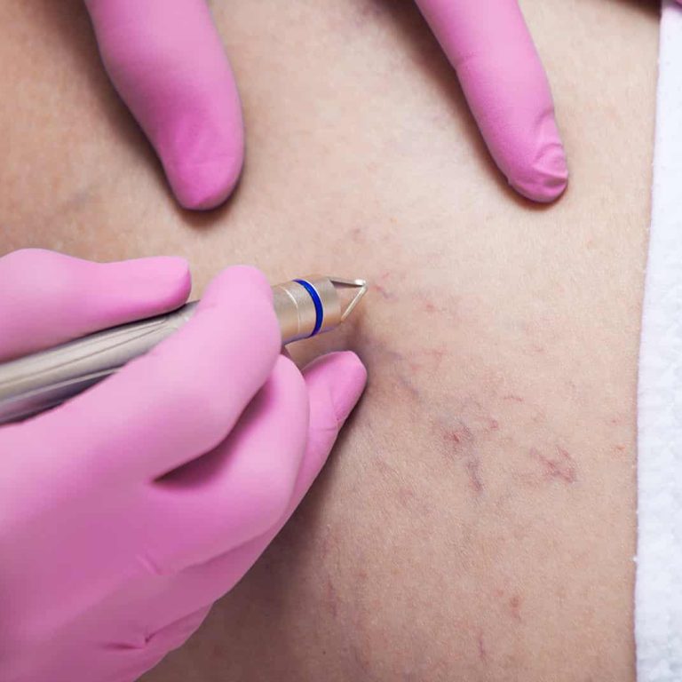 Laser Capillari Aurial