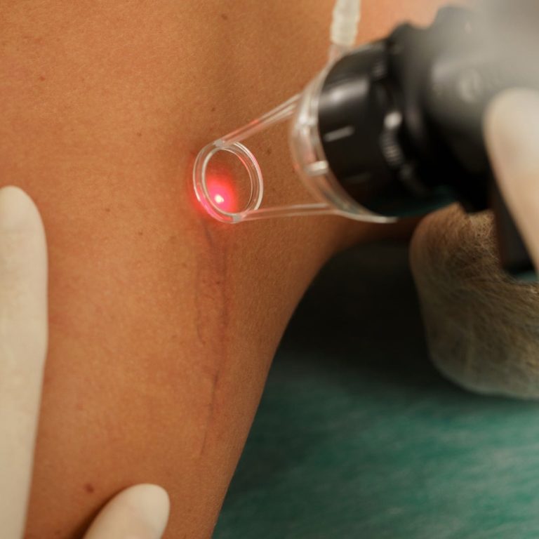 Laser-per-trattamento-cicatrici-Aurial