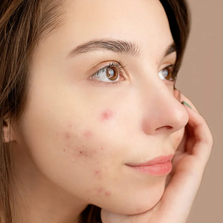 Viso con acne visibile