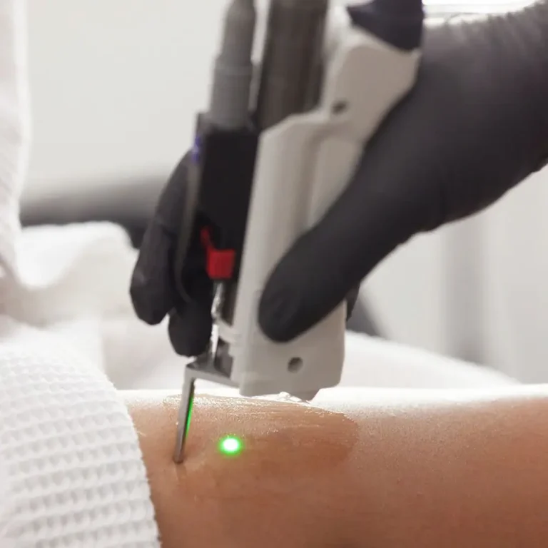 Trattamento laser vascolare