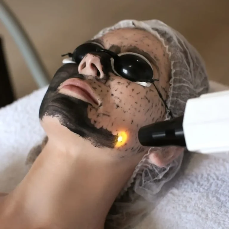 Viso sottoposto a trattamento carbon peel laser