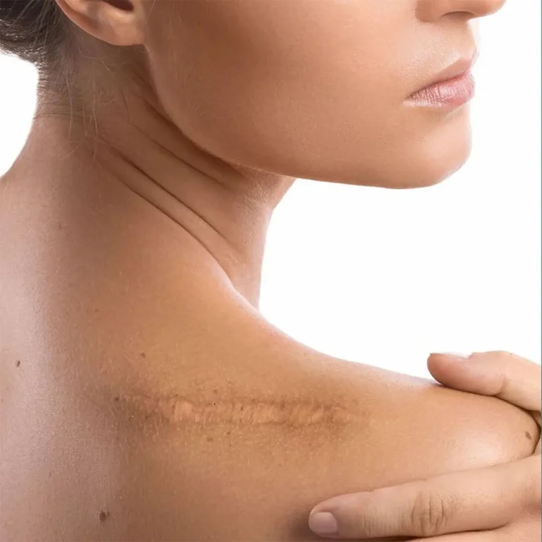 Cicatrice su una spalla rimovibile tramite trattamento laser