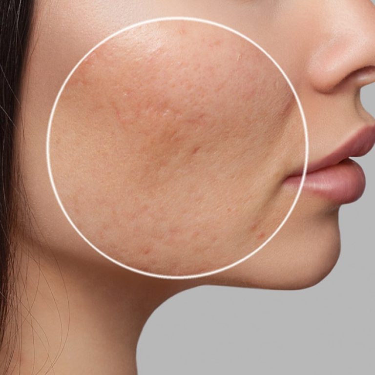 laser cicatrici acne