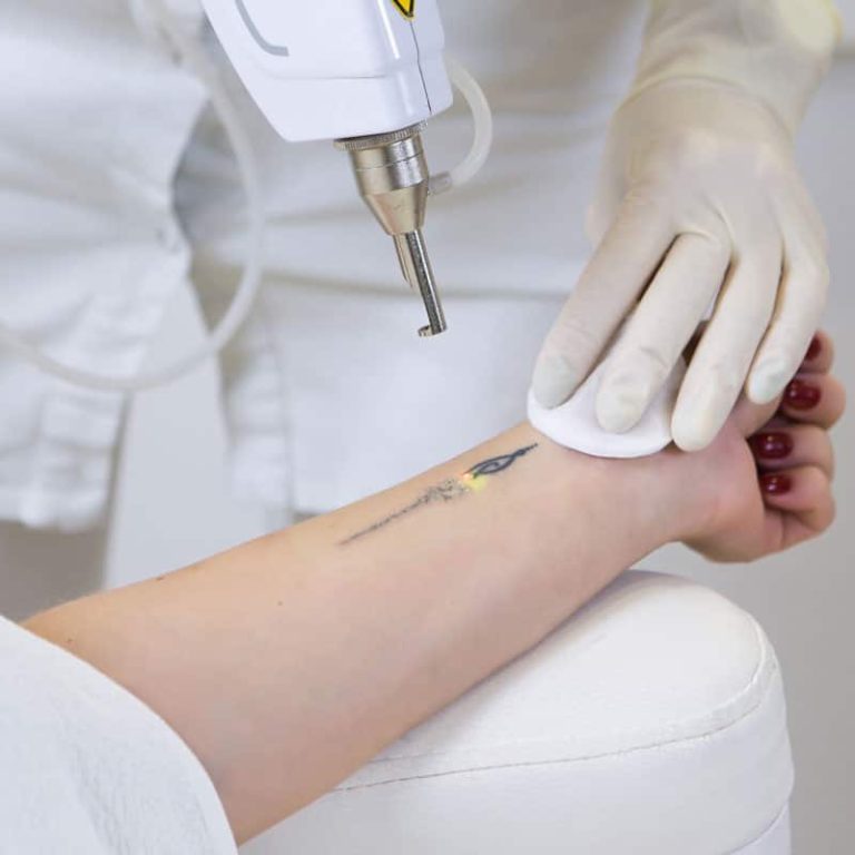 laser rimozione tatuaggi