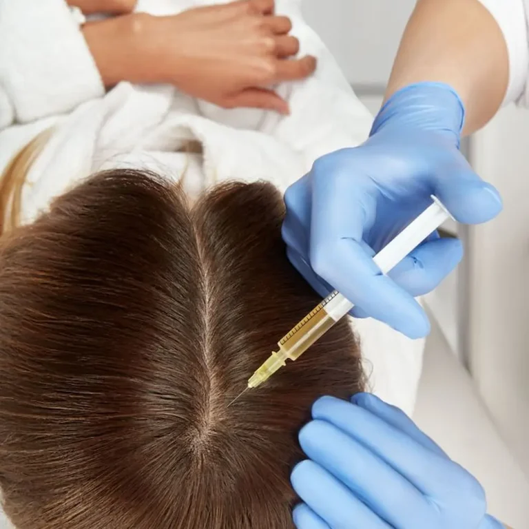 Siringa in una testa con capelli durante trattamento di PRP