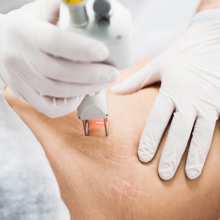 rimozione smagliature