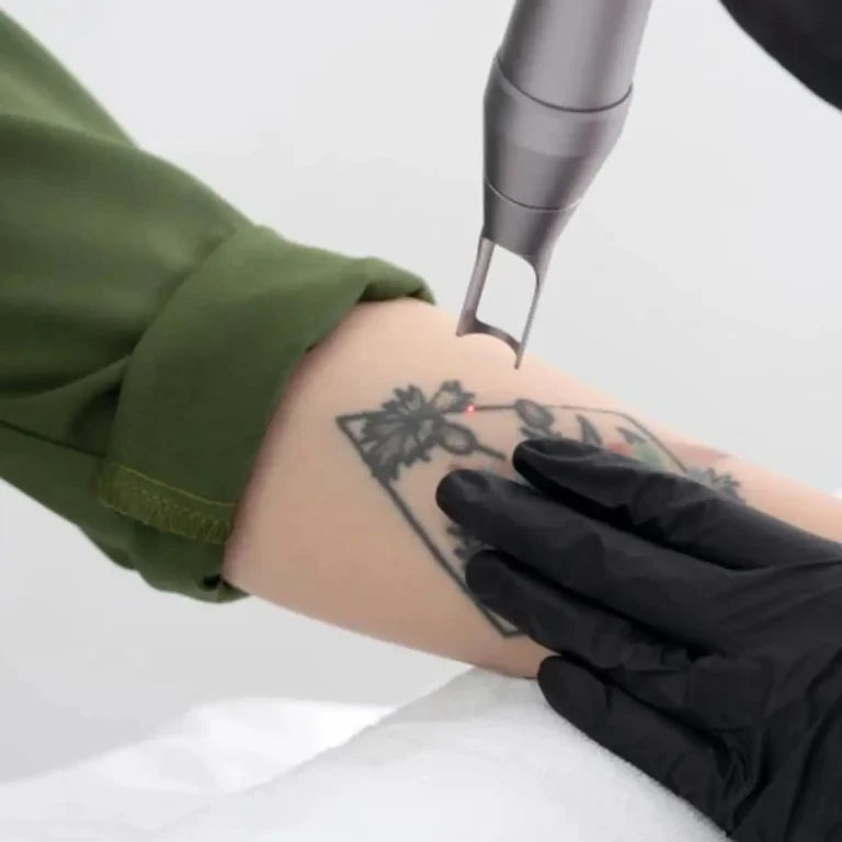 Braccio sottoposto a trattamento rimozione tatuaggio con laser