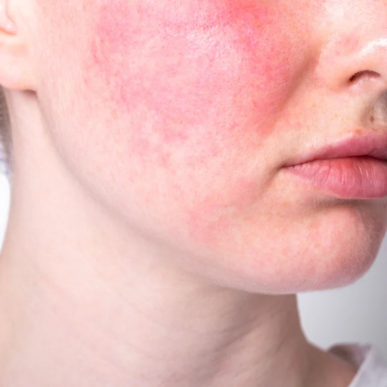 Primo piano di un viso con arrossamento localizzato sulle guance tipico della rosacea e della couperose.