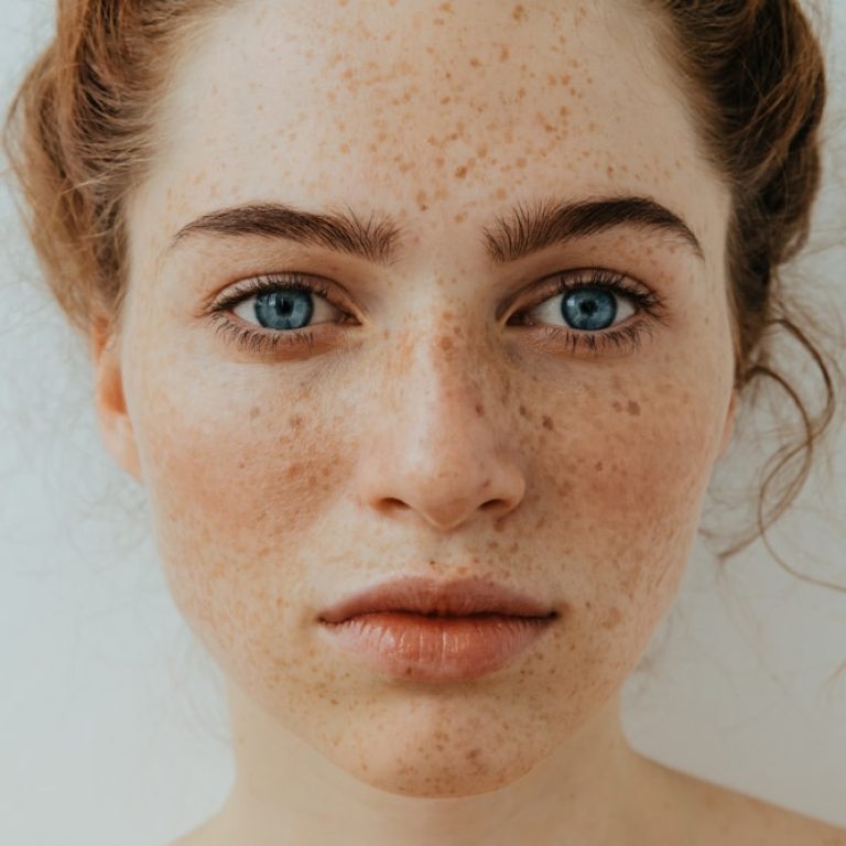 lentigo e macchie in aurial