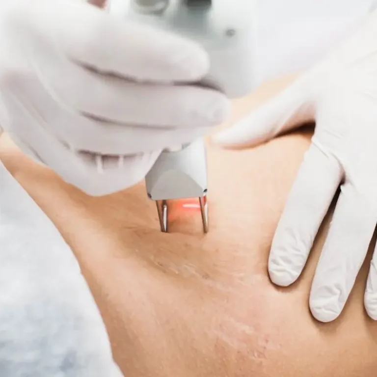 Trattamento per smagliature con laser